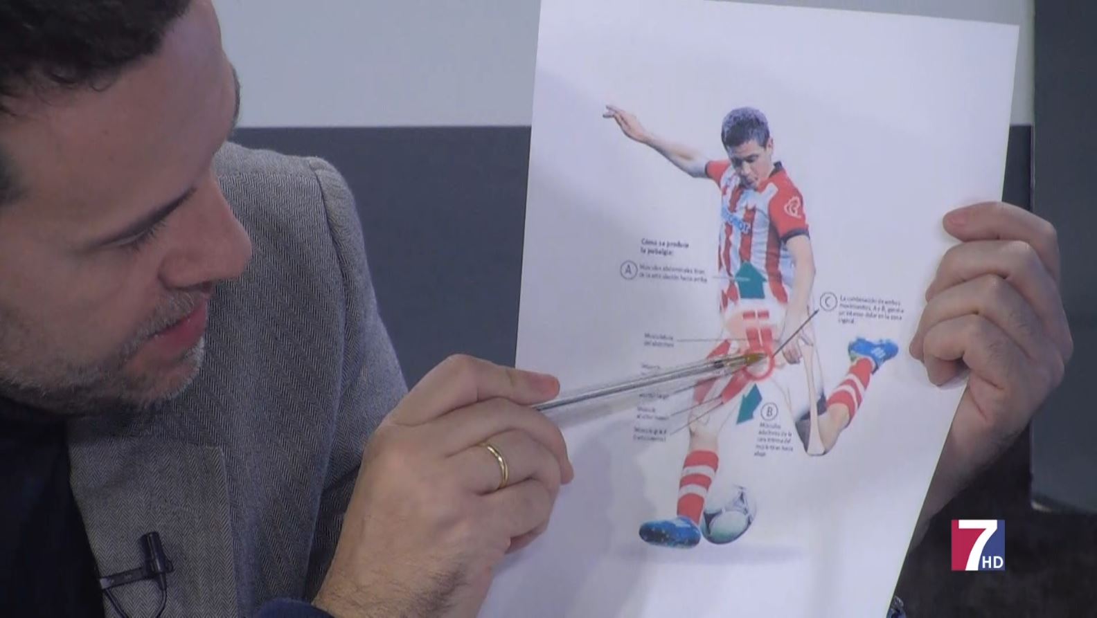 Explicación de la pubalgia